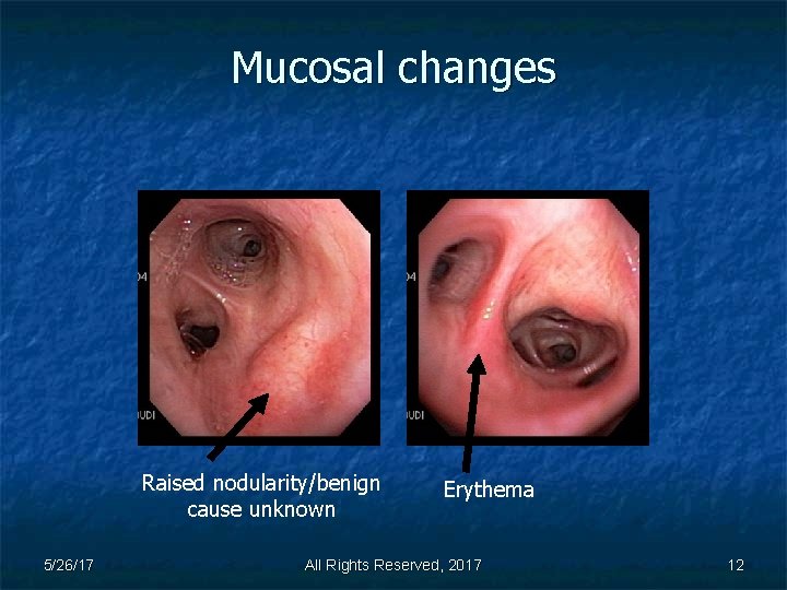 Mucosal changes Raised nodularity/benign cause unknown 5/26/17 Erythema All Rights Reserved, 2017 12 