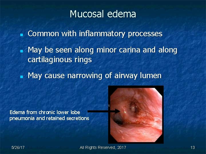 Mucosal edema ■ ■ ■ Common with inflammatory processes May be seen along minor