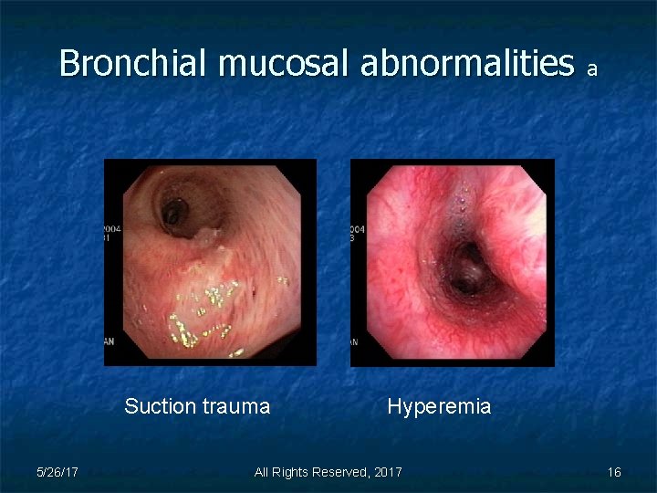 Bronchial mucosal abnormalities a Suction trauma 5/26/17 Hyperemia All Rights Reserved, 2017 16 