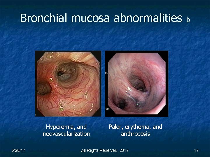 Bronchial mucosa abnormalities b Hyperemia, and neovascularization 5/26/17 Palor, erythema, and anthrocosis All Rights