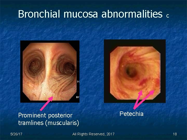Bronchial mucosa abnormalities c Prominent posterior tramlines (muscularis) 5/26/17 All Rights Reserved, 2017 Petechia