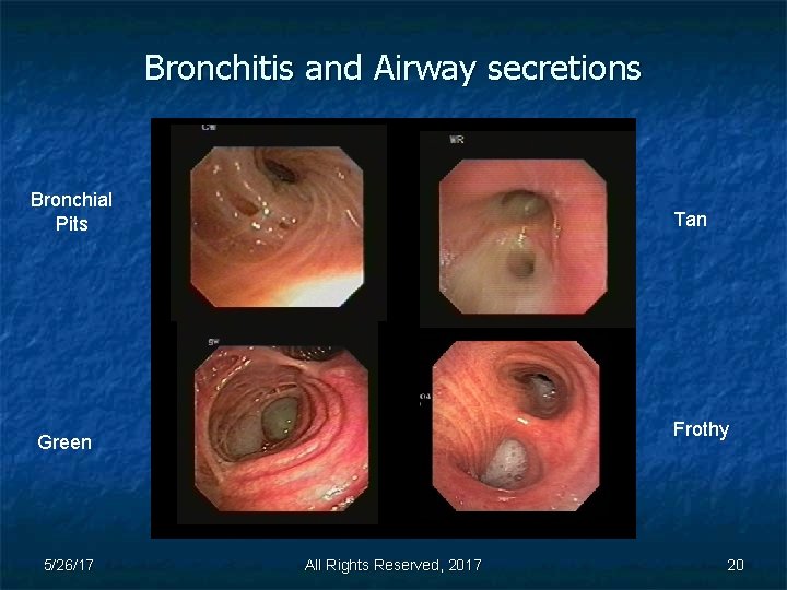 Bronchitis and Airway secretions Bronchial Pits Tan Frothy Green 5/26/17 All Rights Reserved, 2017