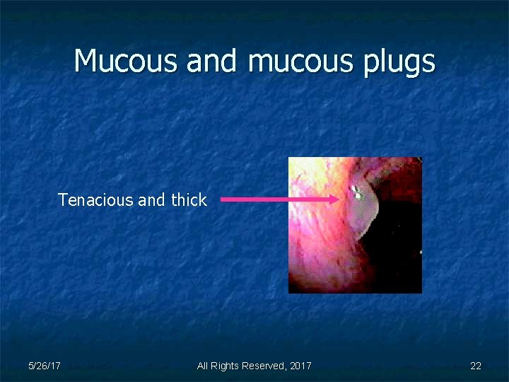 Mucous and mucous plugs Tenacious and thick 5/26/17 All Rights Reserved, 2017 22 
