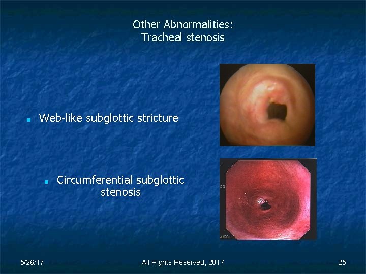 Other Abnormalities: Tracheal stenosis ■ Web-like subglottic stricture ■ 5/26/17 Circumferential subglottic stenosis All