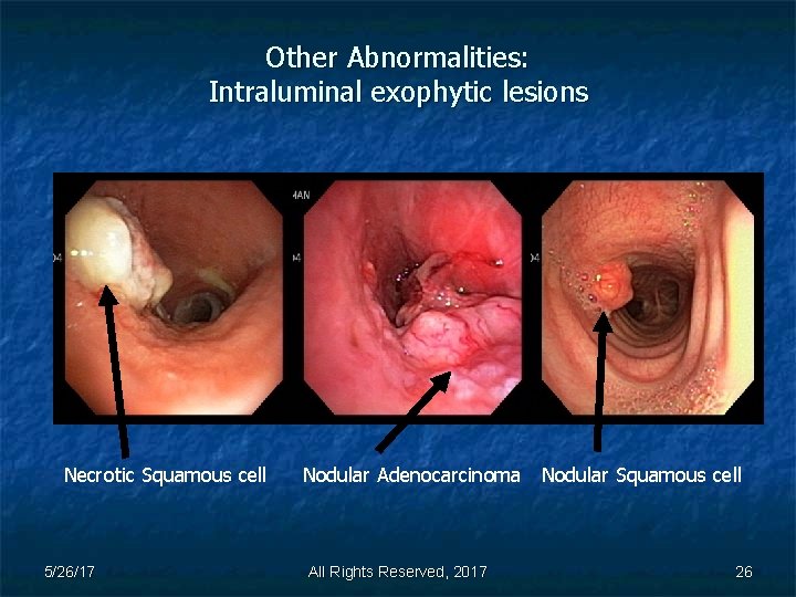 Other Abnormalities: Intraluminal exophytic lesions Necrotic Squamous cell 5/26/17 Nodular Adenocarcinoma Nodular Squamous cell