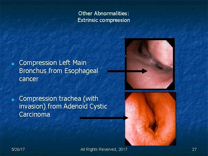 Other Abnormalities: Extrinsic compression ■ ■ Compression Left Main Bronchus from Esophageal cancer Compression