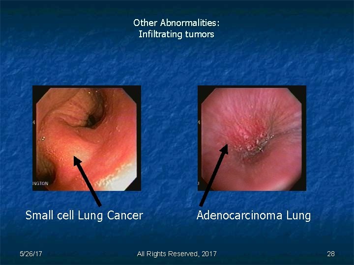 Other Abnormalities: Infiltrating tumors Small cell Lung Cancer 5/26/17 Adenocarcinoma Lung All Rights Reserved,