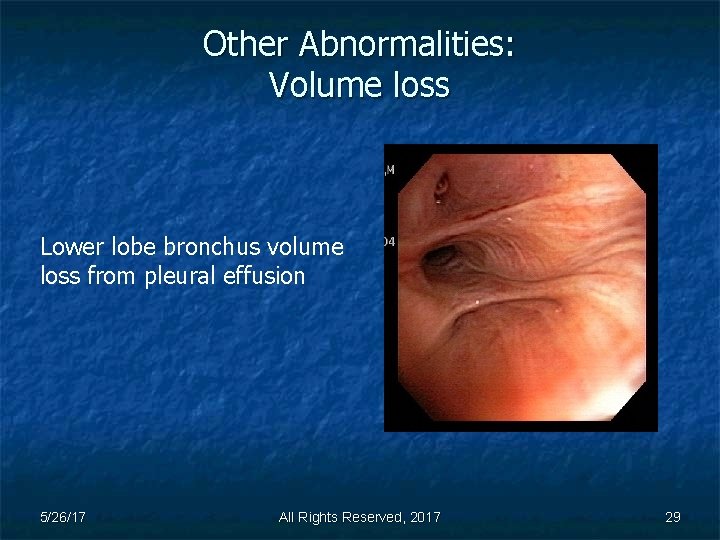 Other Abnormalities: Volume loss Lower lobe bronchus volume loss from pleural effusion 5/26/17 All