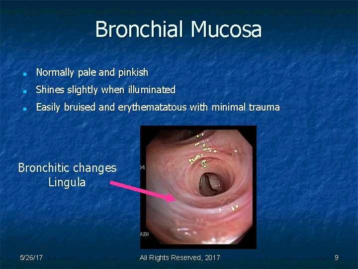Bronchial Mucosa ■ Normally pale and pinkish ■ Shines slightly when illuminated ■ Easily