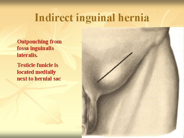 Indirect inguinal hernia Outpouching from fossa inguinalis lateralis. Testicle funicle is located medially next