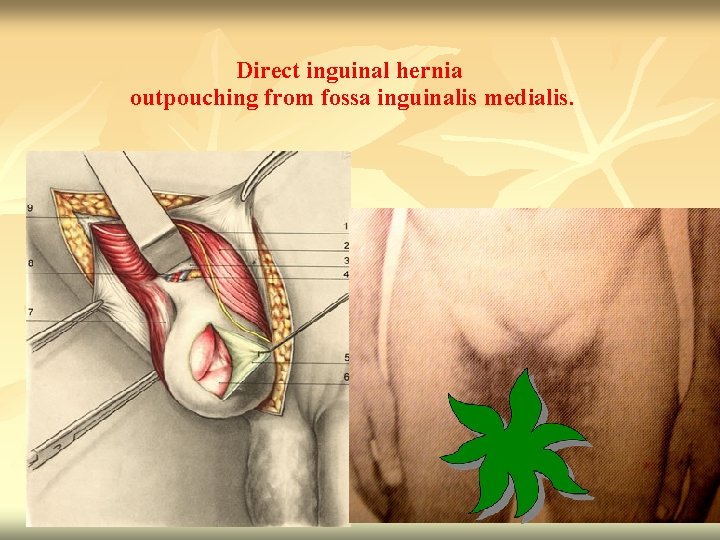 Direct inguinal hernia outpouching from fossa inguinalis medialis. 