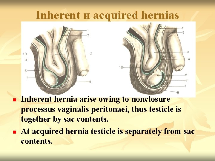 Inherent и acquired hernias n n Inherent hernia arise owing to nonclosure processus vaginalis