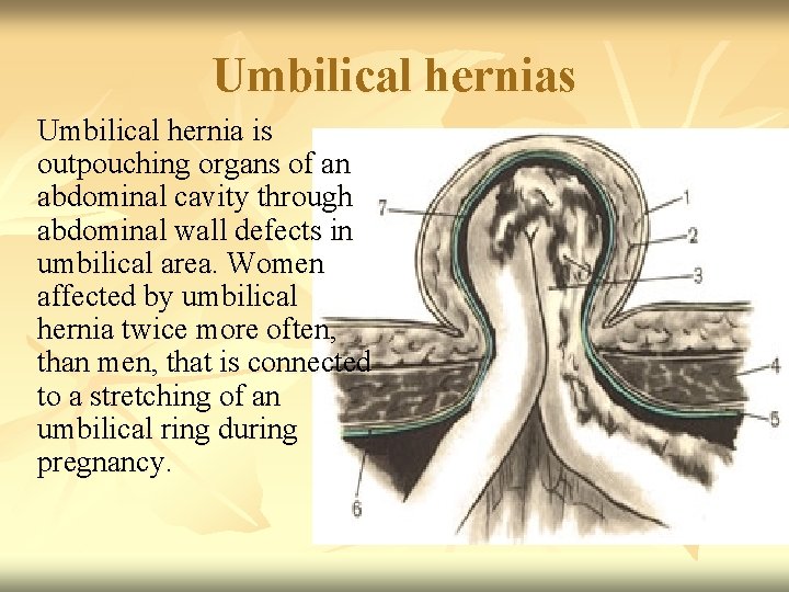 Umbilical hernias Umbilical hernia is outpouching organs of an abdominal cavity through abdominal wall