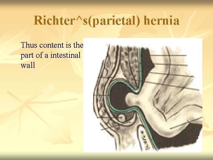 Richter^s(parietal) hernia Thus content is the part of a intestinal wall 