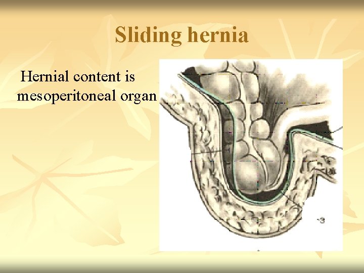 Sliding hernia Hernial content is mesoperitoneal organ 