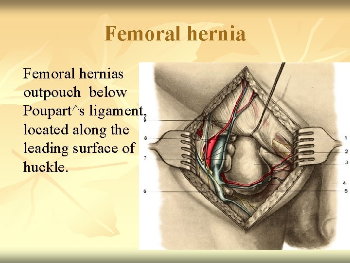 Femoral hernias outpouch below Poupart^s ligament, located along the leading surface of huckle. 