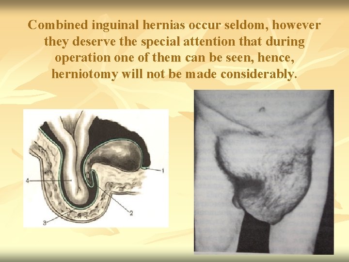 Combined inguinal hernias occur seldom, however they deserve the special attention that during operation