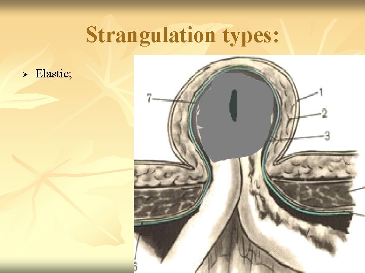 Strangulation types: Ø Elastic; 