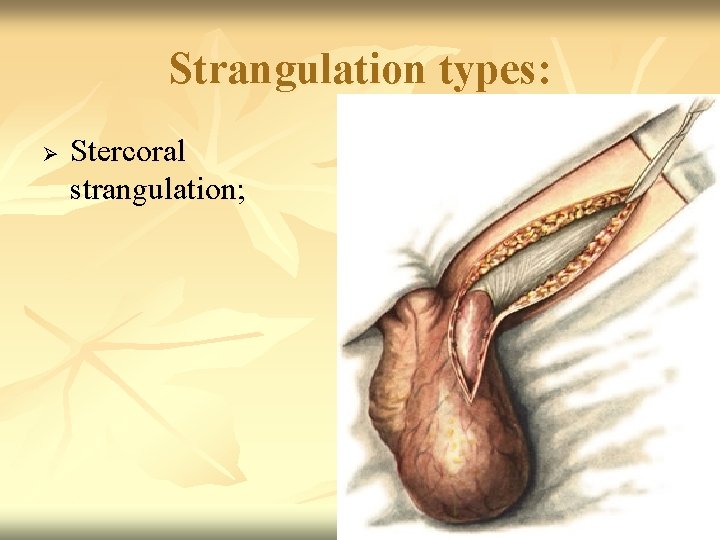 Strangulation types: Ø Stercoral strangulation; 