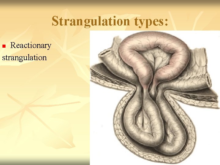 Strangulation types: Reactionary strangulation n 