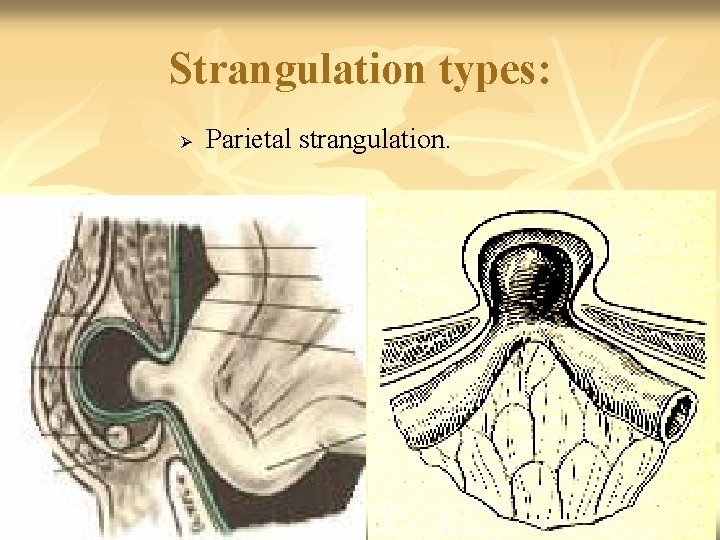 Strangulation types: Ø Parietal strangulation. 