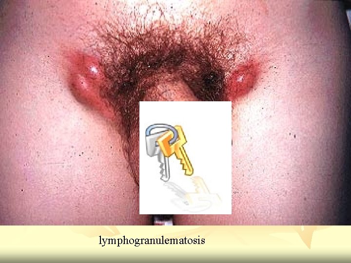 lymphogranulematosis 