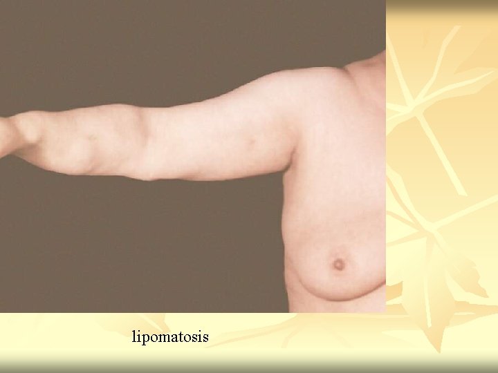 lipomatosis 