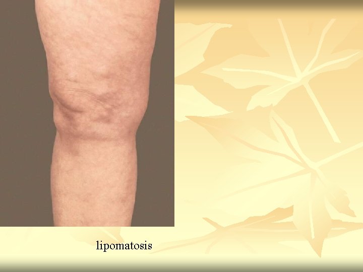 lipomatosis 