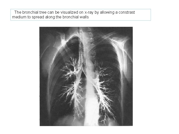 The bronchial tree can be visualized on x-ray by allowing a constrast medium to