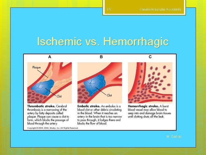 15 Cerebro. Vascular Accidents Ischemic vs. Hemorrhagic M. Dahab 