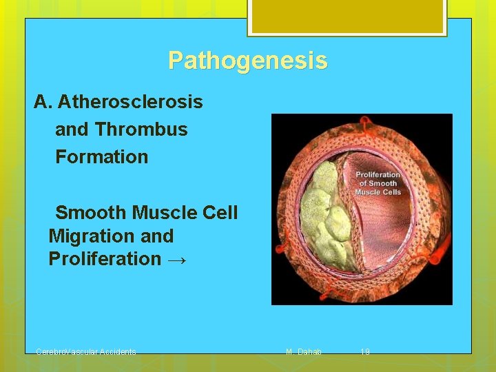 Pathogenesis A. Atherosclerosis and Thrombus Formation Smooth Muscle Cell Migration and Proliferation → Cerebro.