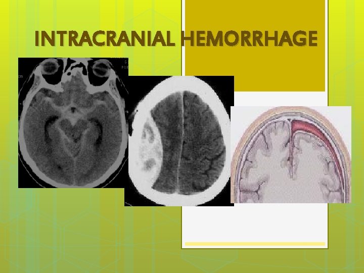 INTRACRANIAL HEMORRHAGE 