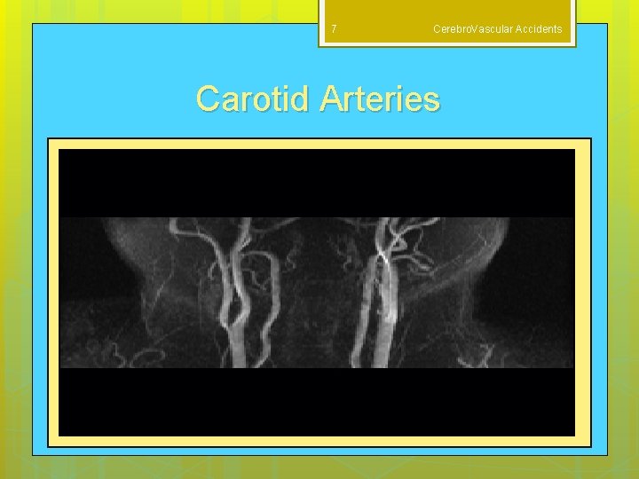 7 Cerebro. Vascular Accidents Carotid Arteries M. Dahab 