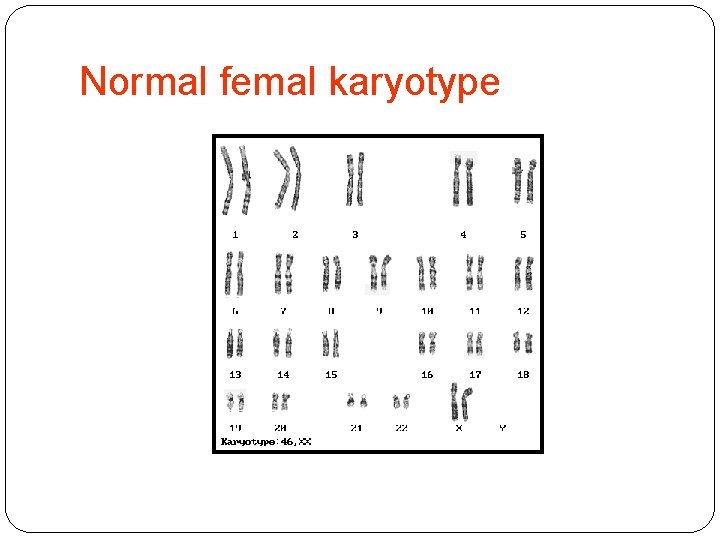 Normal femal karyotype 