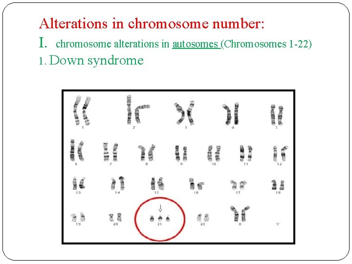 Alterations in chromosome number: I. chromosome alterations in autosomes (Chromosomes 1 -22) 1. Down