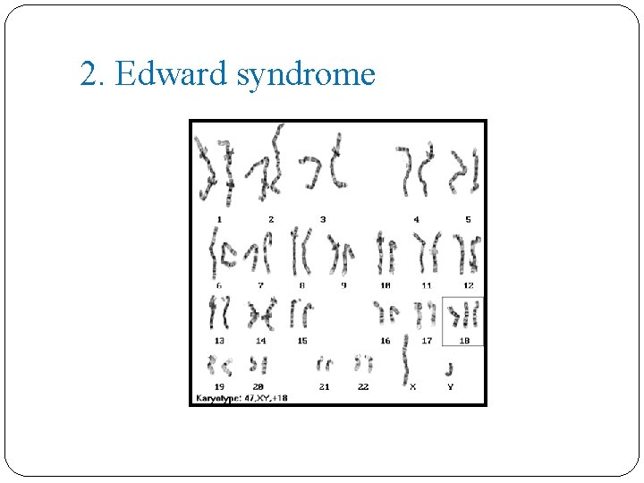 2. Edward syndrome 