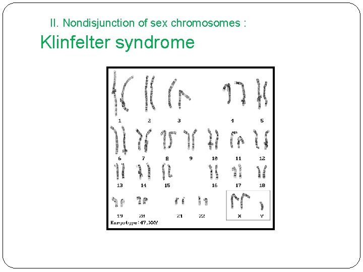 II. Nondisjunction of sex chromosomes : Klinfelter syndrome 