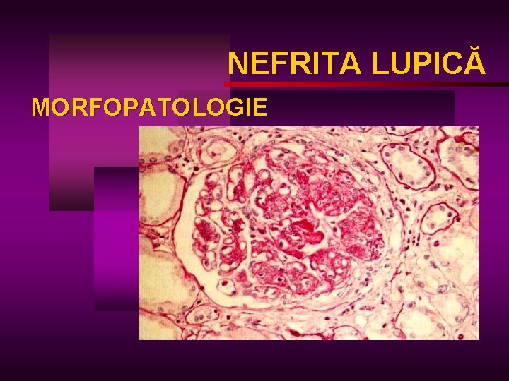 NEFRITA LUPICĂ LUPIC MORFOPATOLOGIE 