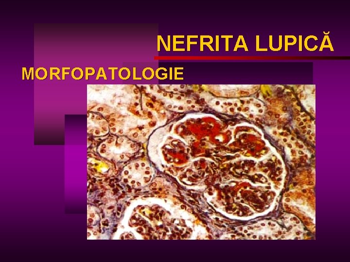 NEFRITA LUPICĂ LUPIC MORFOPATOLOGIE 