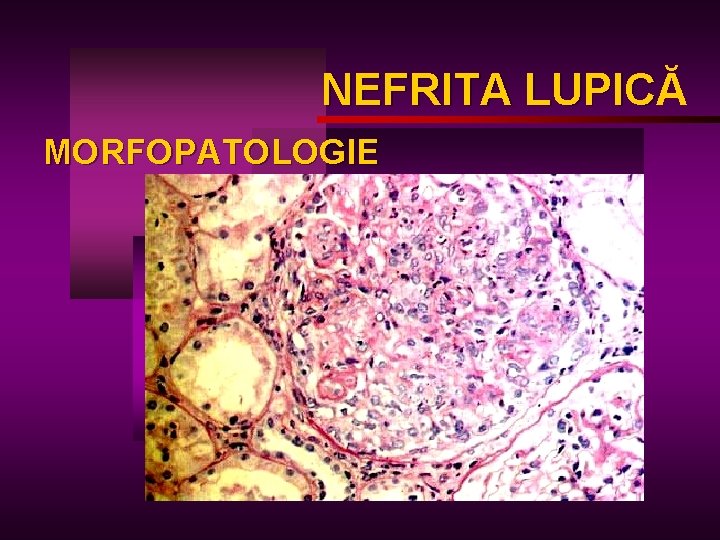 NEFRITA LUPICĂ LUPIC MORFOPATOLOGIE 