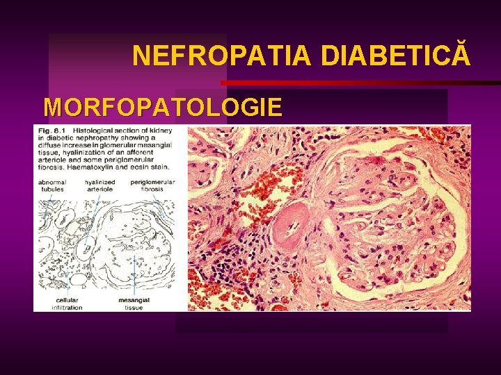 NEFROPATIA DIABETICĂ MORFOPATOLOGIE 