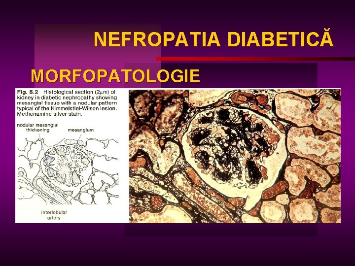 NEFROPATIA DIABETICĂ MORFOPATOLOGIE 