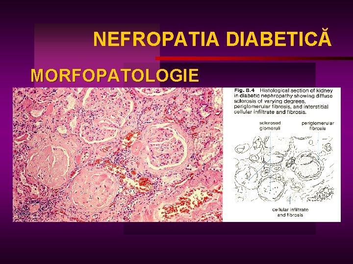 NEFROPATIA DIABETICĂ MORFOPATOLOGIE 