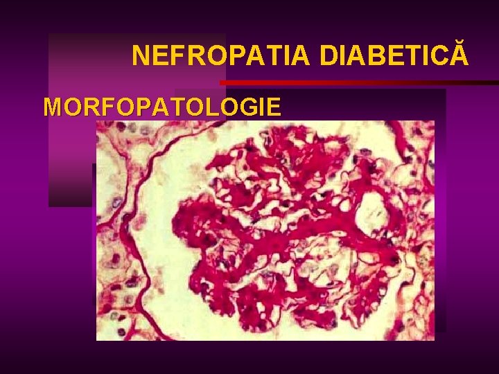 NEFROPATIA DIABETICĂ MORFOPATOLOGIE 