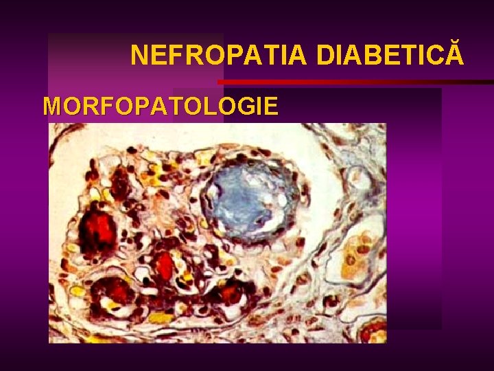 NEFROPATIA DIABETICĂ MORFOPATOLOGIE 