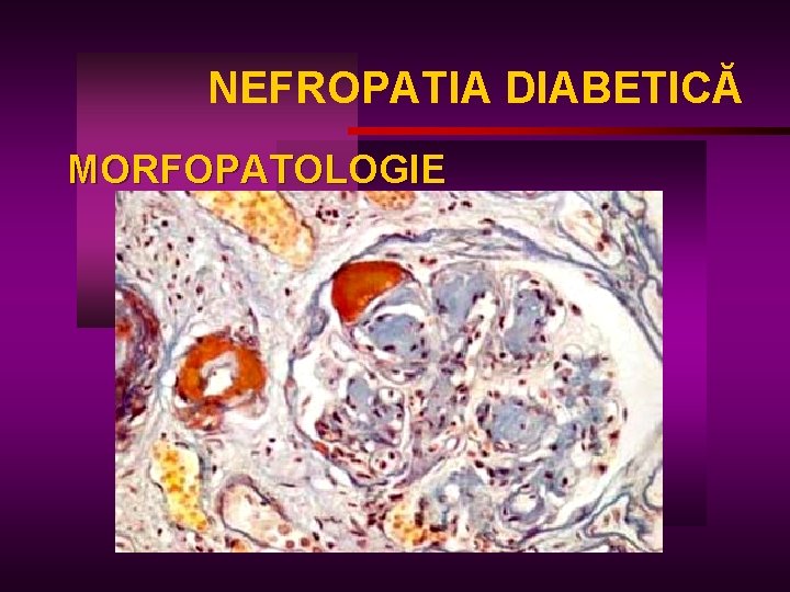 NEFROPATIA DIABETICĂ MORFOPATOLOGIE 