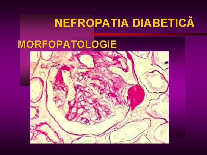 NEFROPATIA DIABETICĂ MORFOPATOLOGIE 