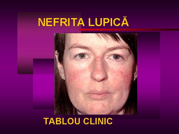NEFRITA LUPICĂ LUPIC TABLOU CLINIC 