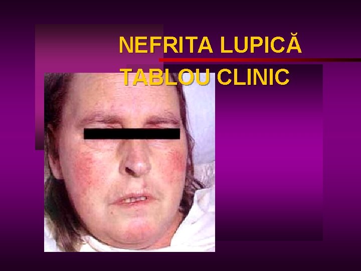 NEFRITA LUPICĂ LUPIC TABLOU CLINIC 