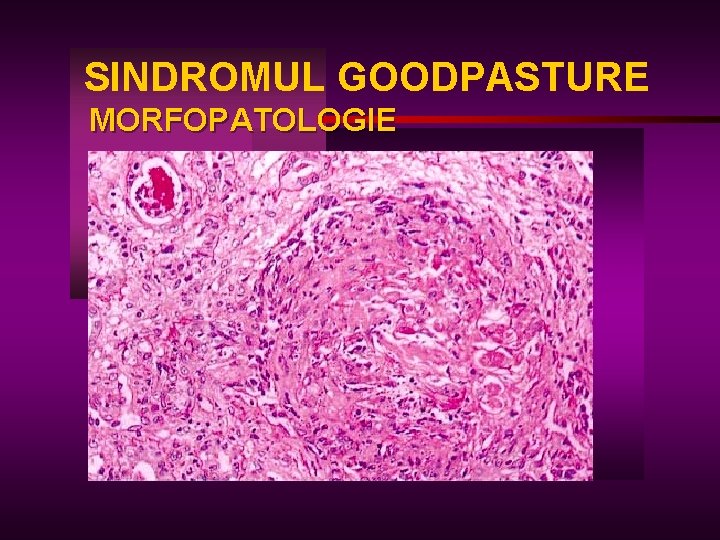 SINDROMUL GOODPASTURE MORFOPATOLOGIE 